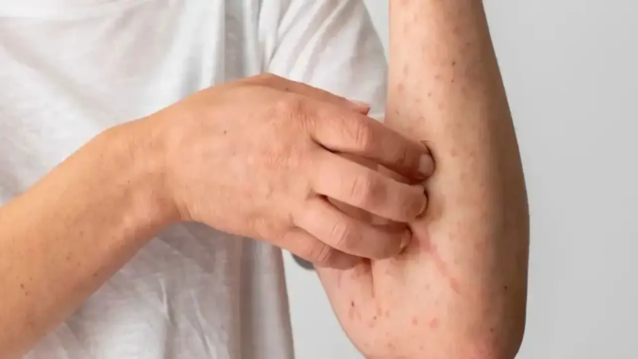 Dünyada Görülen En Nadir Alerji: Patlıcan Alerjisi Nedir?