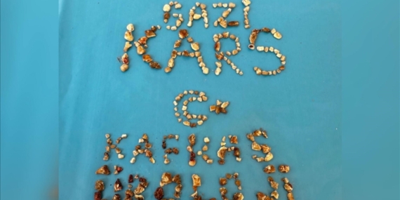 Böbreklerinden 300 Taş Çıktı: Hatıra Diye Eve Götürdü